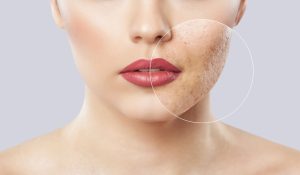 Acne Scar Removal