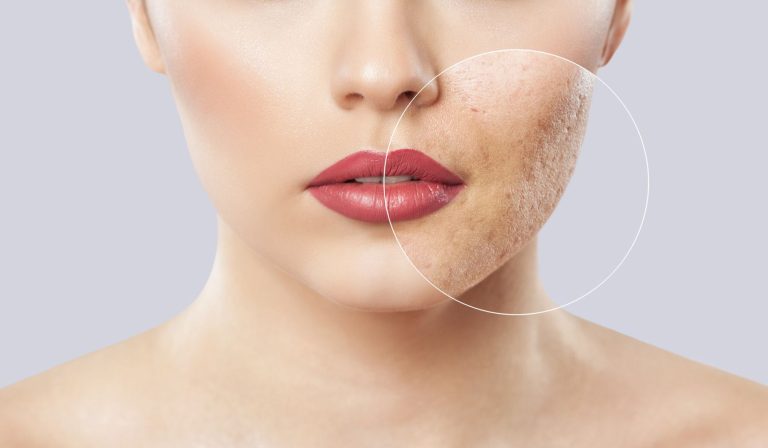 Acne Scar Removal – 3 Ways to Reduce Acne Scars